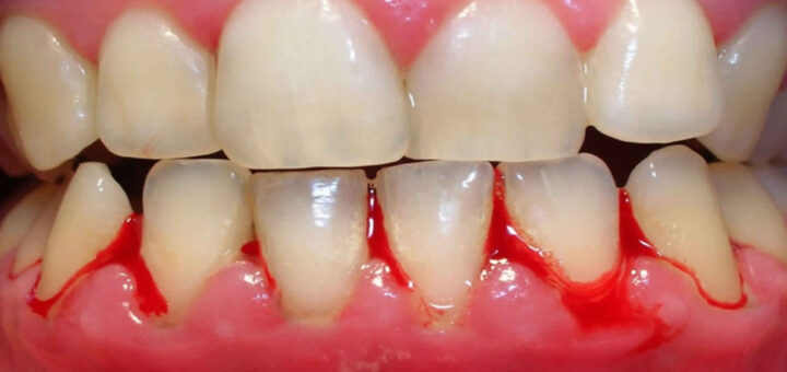 Expert bleeding gum care in Goregaon East , Mumbai